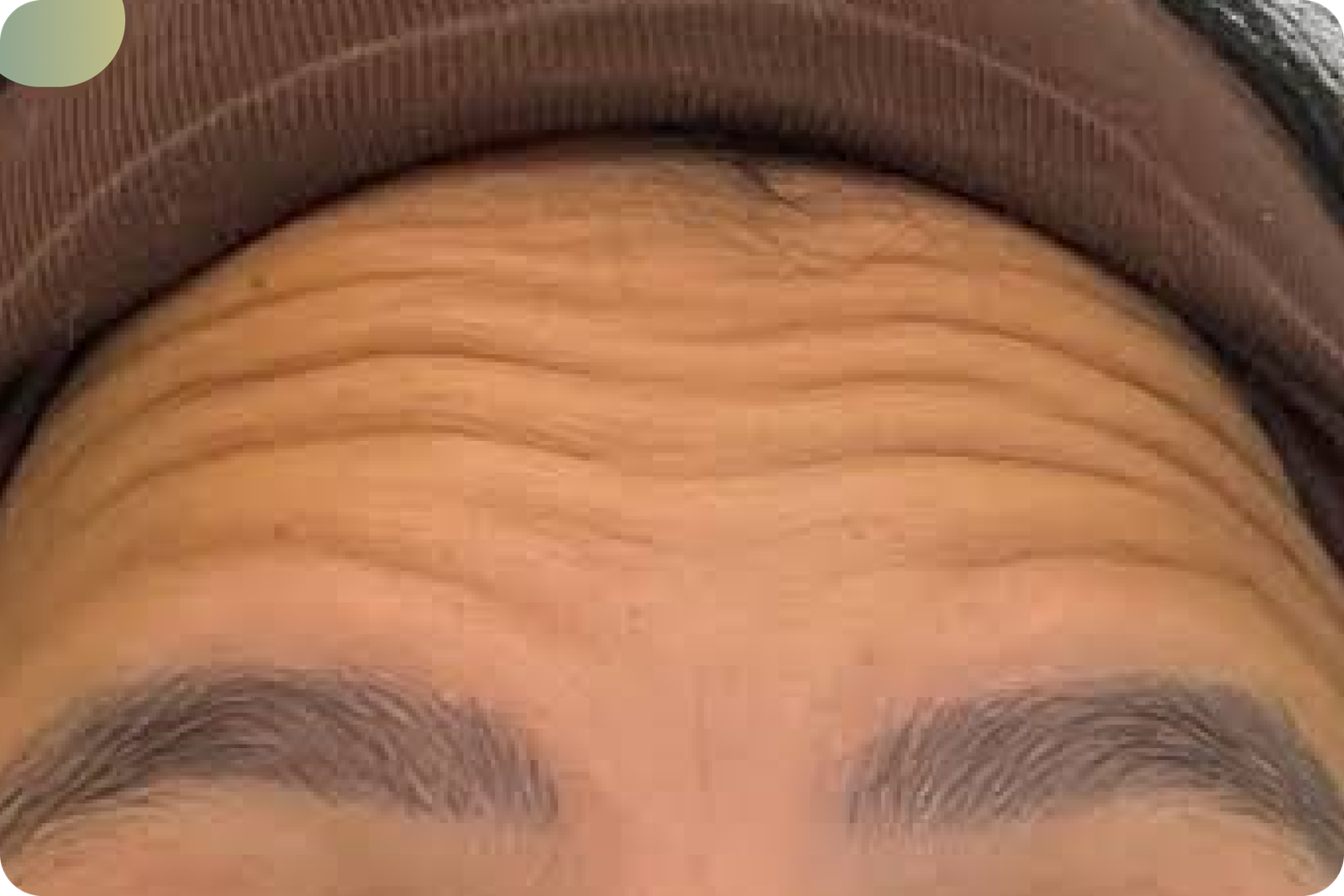 Avant - LASER